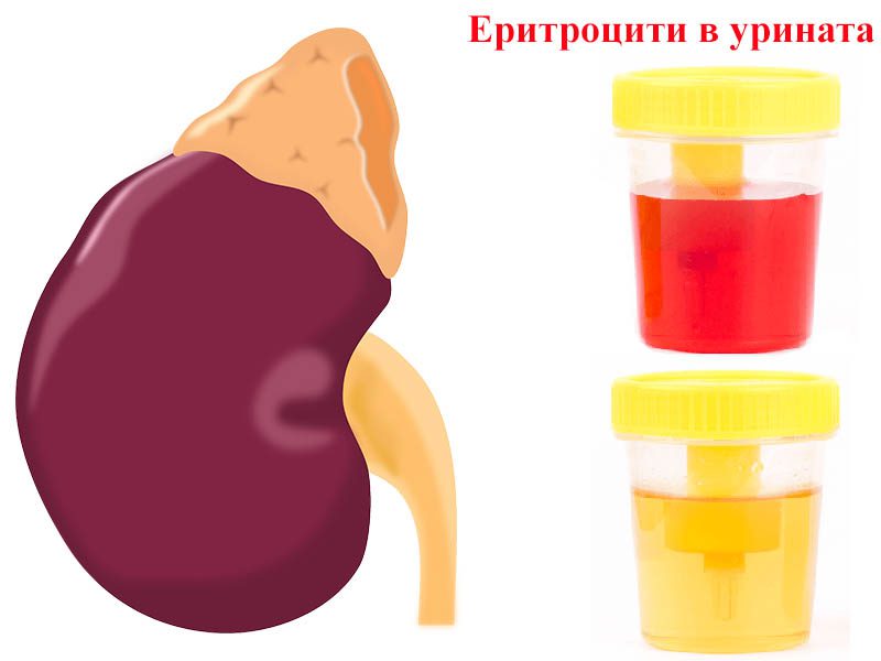 повишени левкоцити в урината